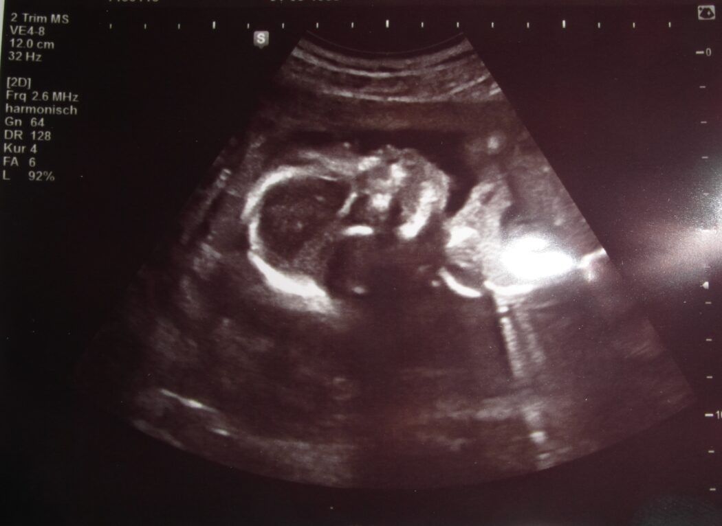 Ultraschall SSW 18