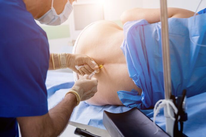 PDA Peridural Anästhesie Geburt Narkose