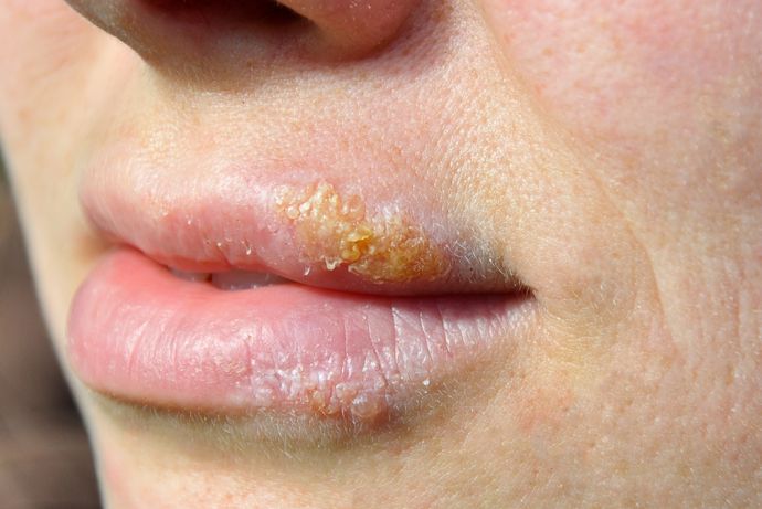 Herpes-gefährlich-fürs-Baby