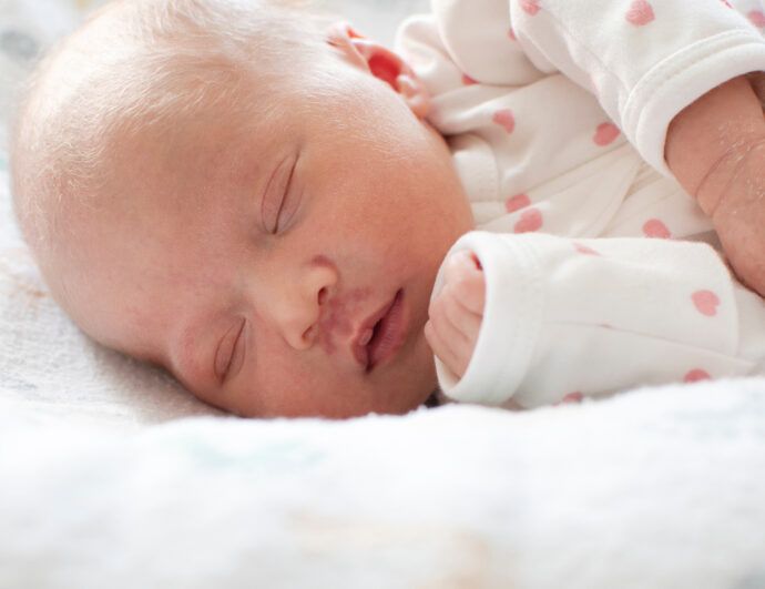 stochenbiss beim baby, feuermal beim baby