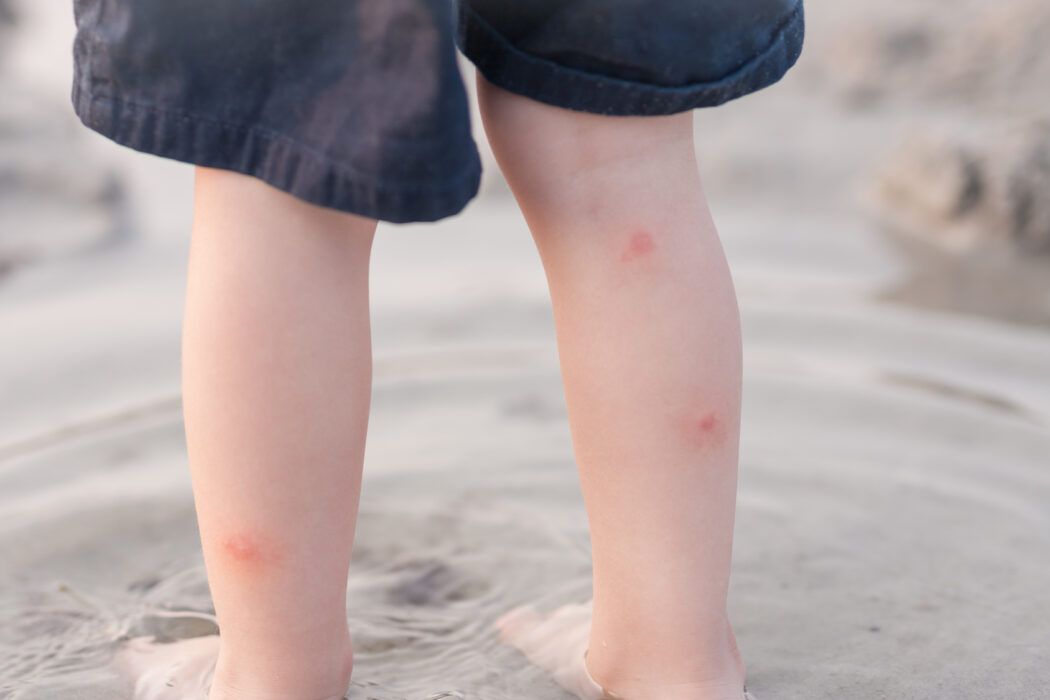 Schutz vor Insektenstichen bei Kindern