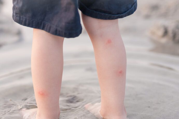 Schutz vor Insektenstichen bei Kindern