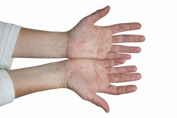 Hand-Mund-Fuß-Krankheit