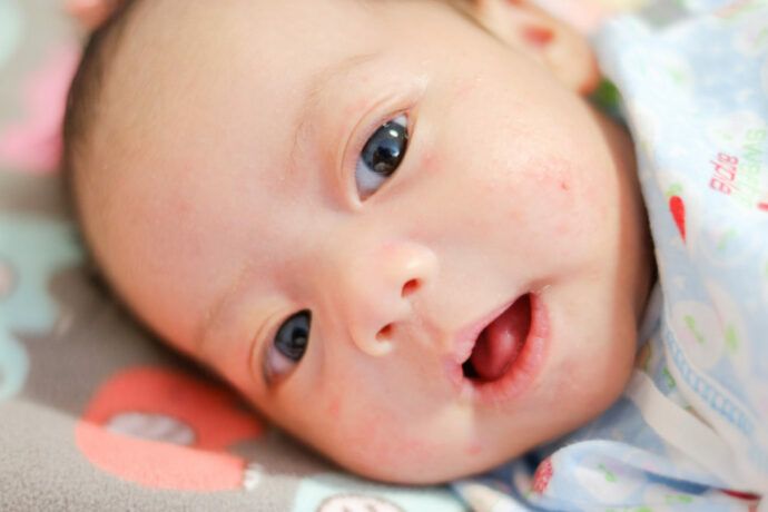 babyakne