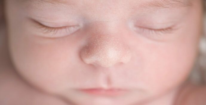Milien beim Baby