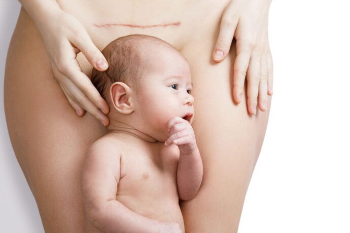 nach einem kaiserschnitt baby verhalten hilfe gesundheit therapie