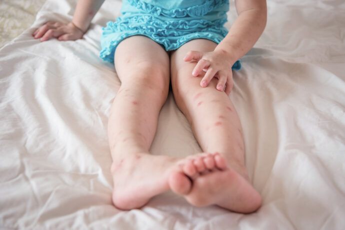 flohbisse mensch kinder baby