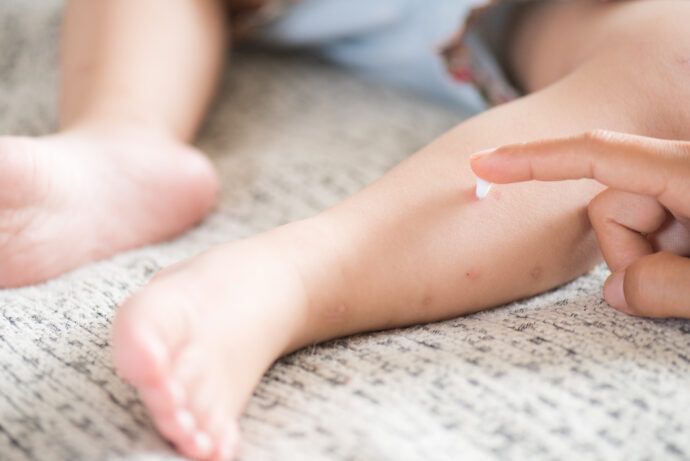 mückenstiche baby kind insekten