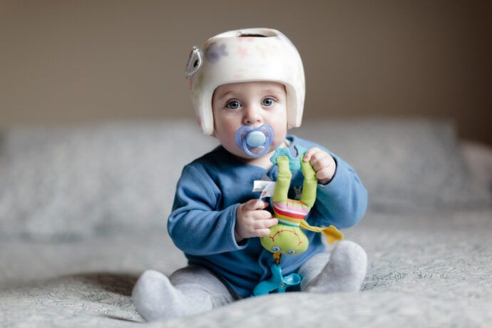 Helmtherapie beim Baby
