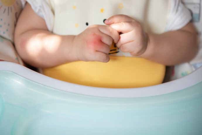Wespenstich beim Kleinkind und Baby