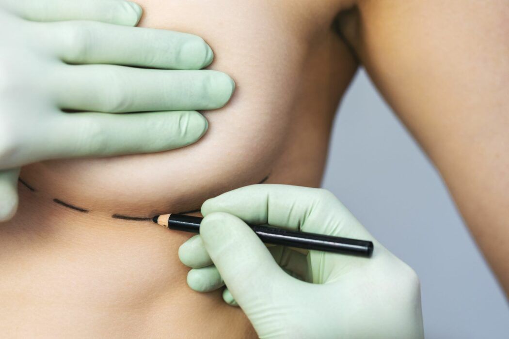 mommy makeover risiken, gefährlich, brustvergrößerung nach geburt, schönheits op nach schwangerschaft, brust-op, bauchdeckenstraffung rektusdiastase after baby body