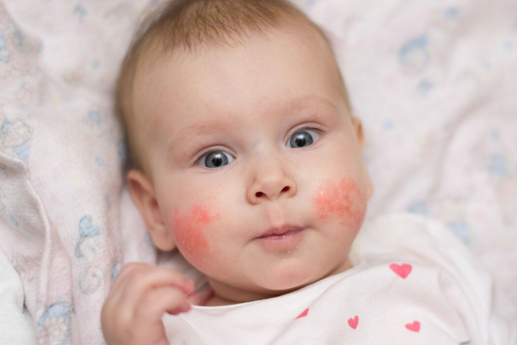 baby rote wangen ausschlag an den backen durch allergie