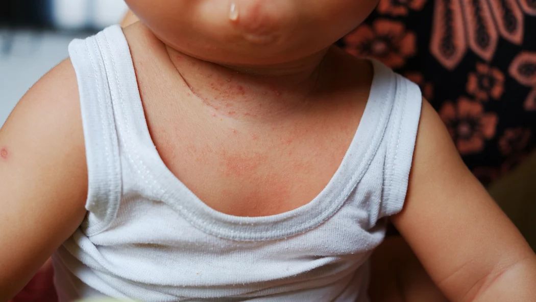 hitzepickel baby hals ausschlag rote punkte