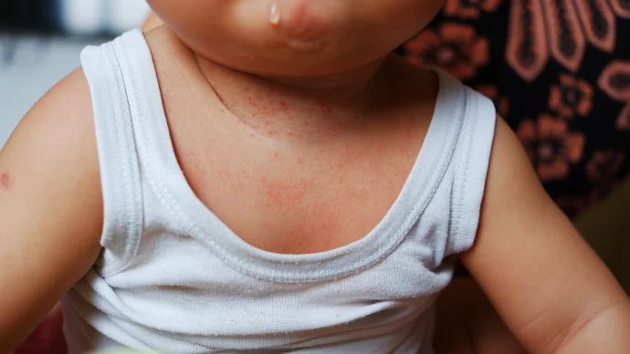 hitzepickel baby hals ausschlag rote punkte