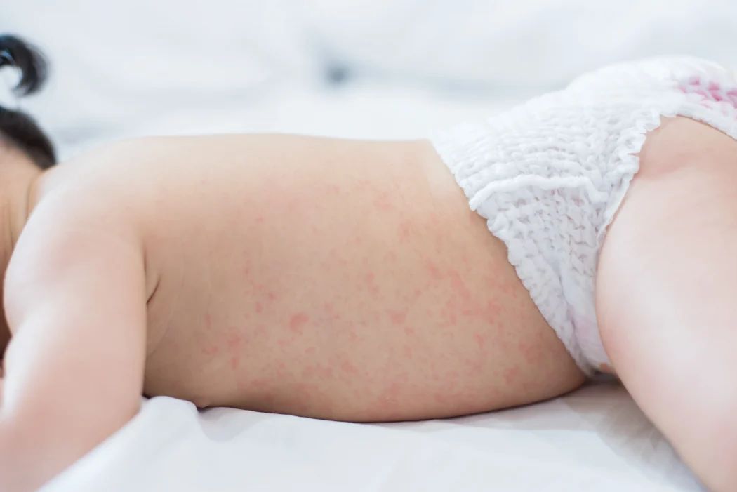 hitzepickel baby rücken rote punkte ausschlag